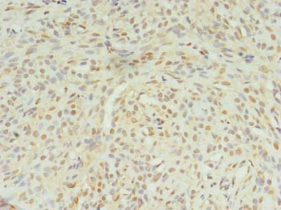 Immunohistochemistry of paraffin-embedded human breast cancer using STK38L Antibody at dilution of 1:100Rabbit anti-Human STK38L Polyclonal Antibody