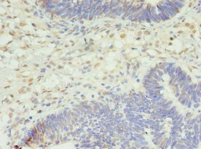 Immunohistochemistry of paraffin-embedded human ovarian cancer using STK38L Antibody at dilution of 1:100Rabbit anti-Human STK38L Polyclonal Antibody