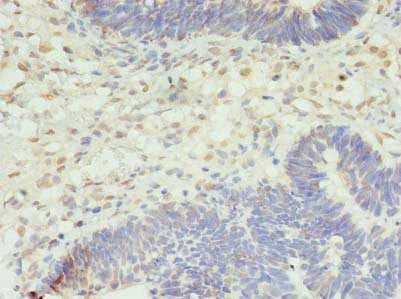 Immunohistochemistry of paraffin-embedded human ovarian cancer using STK38L Antibody at dilution of 1:100Rabbit anti-Human STK38L Polyclonal Antibody