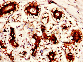 IHC image of PADI2 Antibody diluted at 1:300 and staining in paraffin-embedded human breast cancer performed on a Leica BondTM system. After dewaxing and hydration, antigen retrieval was mediated by high pressure in a citrate buffer (pH 6.0). Section was blocked with 10% normal goat serum 30min at RT. Then primary antibody (1% BSA) was incubated at 4°C overnight. The primary is detected by a biotinylated secondary antibody and visualized using an HRP conjugated SP system.