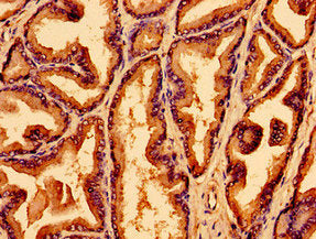 Immunohistochemistry of paraffin-embedded human prostate tissue using WNK2 Antibody at dilution of 1:100