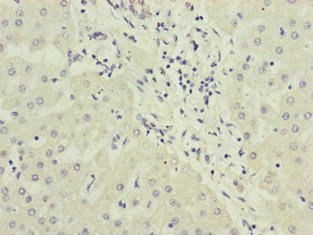 Immunohistochemistry of paraffin-embedded human liver cancer using PPP2R3B Antibody at dilution of 1:100Rabbit anti-Human PPP2R3B Polyclonal Antibody
