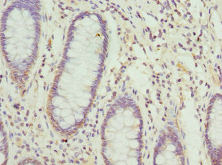 Immunohistochemistry of paraffin-embedded human colon cancer using NFS1 Antibody at dilution of 1:100Rabbit anti-Human NFS1 Polyclonal Antibody