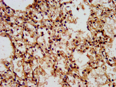 IHC image of WASF2 Antibody diluted at 1:500 and staining in paraffin-embedded human lung tissue performed on a Leica BondTM system. After dewaxing and hydration, antigen retrieval was mediated by high pressure in a citrate buffer (pH 6.0). Section was blocked with 10% normal goat serum 30min at RT. Then primary antibody (1% BSA) was incubated at 4°C overnight. The primary is detected by a biotinylated secondary antibody and visualized using an HRP conjugated SP system.Rabbit anti-Human WASF2 Polyclonal Antibody
