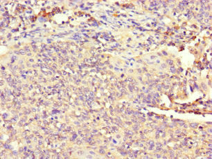 Immunohistochemistry of paraffin-embedded human cervical cancer using the antibody at dilution of 1:100