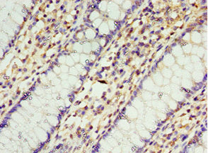 Immunohistochemistry of paraffin-embedded human colon cancer using STRAP Antibody at dilution of 1:100Rabbit anti-Human STRAP Polyclonal Antibody