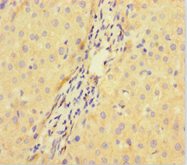 Immunohistochemistry of paraffin-embedded human liver cancer using the antibody at dilution of 1:100