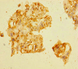 Immunohistochemistry of paraffin-embedded human pancreatic cancer using DCAF1 Antibody at dilution of 1:100