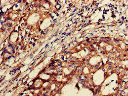 Immunohistochemistry of paraffin-embedded human gastric cancer using BACE2 Antibody at dilution of 1:100