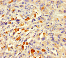 Immunohistochemistry of paraffin-embedded human melanoma using ACTL7A Antibody at dilution of 1:100