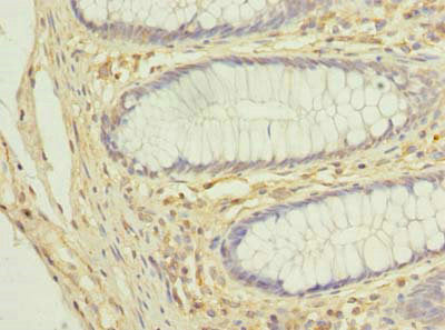 Immunohistochemistry of paraffin-embedded human colon cancer using the antibody at dilution of 1:100Rabbit anti-Human COX11 Polyclonal Antibody