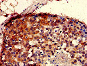 Immunohistochemistry of paraffin-embedded human breast cancer using SEC23IP Antibody at dilution of 1:100Rabbit anti-Human SEC23IP Polyclonal Antibody