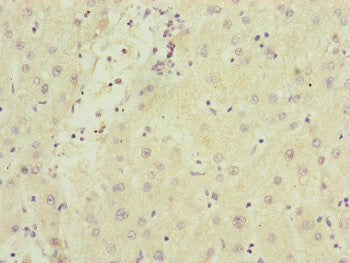 Immunohistochemistry of paraffin-embedded human liver cancer using SAMM50 Antibody at dilution of 1:100Rabbit anti-Human SAMM50 Polyclonal Antibody