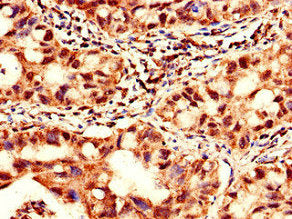 Immunohistochemistry of paraffin-embedded human lung cancer using YTHDF2 Antibody at dilution of 1:100Rabbit anti-Human YTHDF2 Polyclonal Antibody
