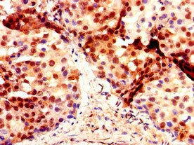 Immunohistochemistry of paraffin-embedded human breast cancer using DMRT1 Antibody at dilution of 1:100Rabbit anti-Human DMRT1 Polyclonal Antibody