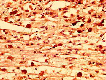 IHC image of LRRFIP2 Antibody diluted at 1:300 and staining in paraffin-embedded human melanoma performed on a Leica BondTM system. After dewaxing and hydration, antigen retrieval was mediated by high pressure in a citrate buffer (pH 6.0). Section was blocked with 10% normal goat serum 30min at RT. Then primary antibody (1% BSA) was incubated at 4°C overnight. The primary is detected by a biotinylated secondary antibody and visualized using an HRP conjugated SP system.
