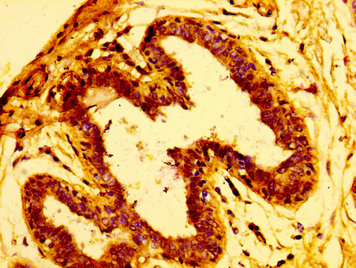IHC image of ARFGEF2 Antibody diluted at 1:100 and staining in paraffin-embedded human breast cancer performed on a Leica BondTM system. After dewaxing and hydration, antigen retrieval was mediated by high pressure in a citrate buffer (pH 6.0). Section was blocked with 10% normal goat serum 30min at RT. Then primary antibody (1% BSA) was incubated at 4°C overnight. The primary is detected by a biotinylated secondary antibody and visualized using an HRP conjugated SP system.Rabbit anti-Human ARFGEF2 Polyclonal Antibody