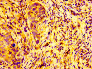 IHC image of ARFGEF2 Antibody diluted at 1:100 and staining in paraffin-embedded human pancreatic cancer performed on a Leica BondTM system. After dewaxing and hydration, antigen retrieval was mediated by high pressure in a citrate buffer (pH 6.0). Section was blocked with 10% normal goat serum 30min at RT. Then primary antibody (1% BSA) was incubated at 4°C overnight. The primary is detected by a biotinylated secondary antibody and visualized using an HRP conjugated SP system.Rabbit anti-Human ARFGEF2 Polyclonal Antibody