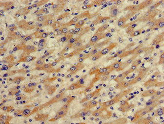 Immunohistochemistry of paraffin-embedded human liver cancer using SLCO1B1 Antibody at dilution of 1:100Rabbit anti-Human SLCO1B1 Polyclonal Antibody