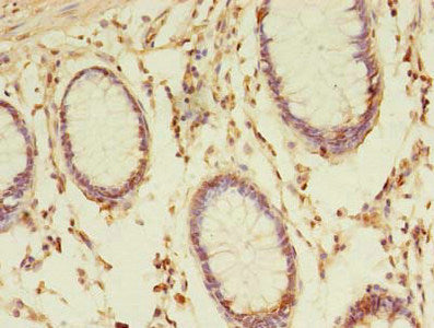 Immunohistochemistry of paraffin-embedded human colon cancer using TMED3 Antibody at dilution of 1:100Rabbit anti-Human TMED3 Polyclonal Antibody