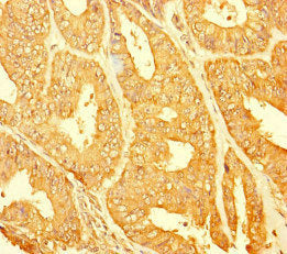 Immunohistochemistry of paraffin-embedded human endometrial cancer using CHTOP Antibody at dilution of 1:100Rabbit anti-Human CHTOP Polyclonal Antibody