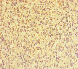 Immunohistochemistry of paraffin-embedded human glioma using CHTOP Antibody at dilution of 1:100Rabbit anti-Human CHTOP Polyclonal Antibody