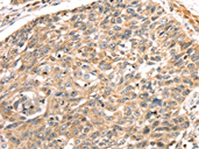 The image on the left is immunohistochemistry of paraffin-embedded Human lung cancer tissue using LONP1 Antibody(LONP1 Antibody) at dilution 1/25, on the right is treated with synthetic peptide. (Original magnification: ×200)