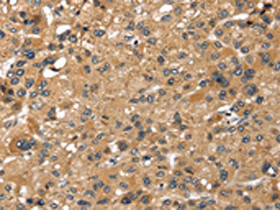 The image on the left is immunohistochemistry of paraffin-embedded Human liver cancer tissue using the antibody Antibody) at dilution 1/25, on the right is treated with synthetic peptide. (Original magnification: ×200)