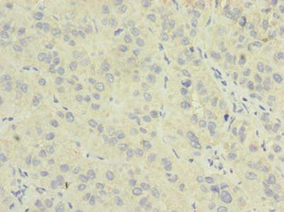 Immunohistochemistry of paraffin-embedded human liver cancer using NME7 Antibody at dilution of 1:100Rabbit anti-Human NME7 Polyclonal Antibody