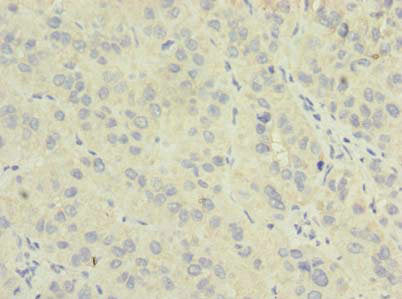 Immunohistochemistry of paraffin-embedded human liver cancer using NME7 Antibody at dilution of 1:100Rabbit anti-Human NME7 Polyclonal Antibody