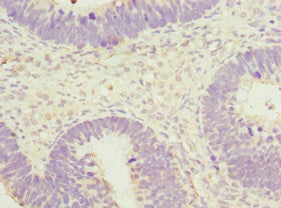 Immunohistochemistry of paraffin-embedded human ovarian cancer using SPIN1 Antibody at dilution of 1:100Rabbit anti-Human SPIN1 Polyclonal Antibody