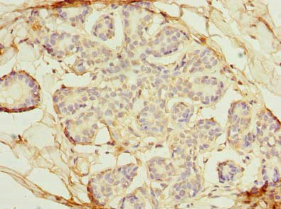 Immunohistochemistry of paraffin-embedded human breast cancer using OSGIN2 Antibody at dilution of 1:100Rabbit anti-Human OSGIN2 Polyclonal Antibody
