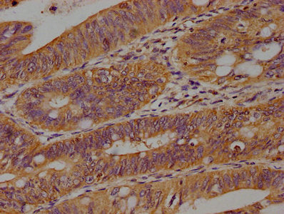 IHC image of the antibody diluted at 1:100 and staining in paraffin-embedded human colon cancer performed on a Leica BondTM system. After dewaxing and hydration, antigen retrieval was mediated by high pressure in a citrate buffer (pH 6.0). Section was blocked with 10% normal goat serum 30min at RT. Then primary antibody (1% BSA) was incubated at 4°C overnight. The primary is detected by a biotinylated secondary antibody and visualized using an HRP conjugated SP system.