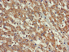 Immunohistochemistry of paraffin-embedded human liver cancer using FARP1 Antibody at dilution of 1:100Rabbit anti-Human FARP1 Polyclonal Antibody