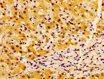 IHC image of SSX2IP Antibody diluted at 1:100 and staining in paraffin-embedded human liver cancer performed on a Leica BondTM system. After dewaxing and hydration, antigen retrieval was mediated by high pressure in a citrate buffer (pH 6.0). Section was blocked with 10% normal goat serum 30min at RT. Then primary antibody (1% BSA) was incubated at 4°C overnight. The primary is detected by a biotinylated secondary antibody and visualized using an HRP conjugated SP system.
