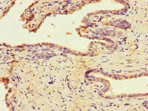 Immunohistochemistry of paraffin-embedded human prostate cancer using the antibody at dilution of 1:100