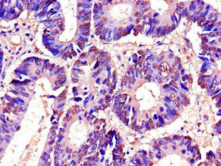 Immunohistochemistry of paraffin-embedded human colon cancer using RTCB Antibody at dilution of 1:100Rabbit anti-Human RTCB Polyclonal Antibody