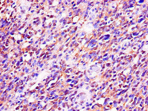 Immunohistochemistry of paraffin-embedded human glioma using RTCB Antibody at dilution of 1:100Rabbit anti-Human RTCB Polyclonal Antibody