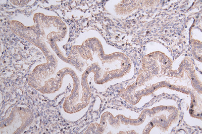 Immunohistochemistry of paraffin-embedded human endometrial cancer using TRIM17 Antibody at dilution of 1:67Rabbit anti-Human TRIM17 Polyclonal Antibody