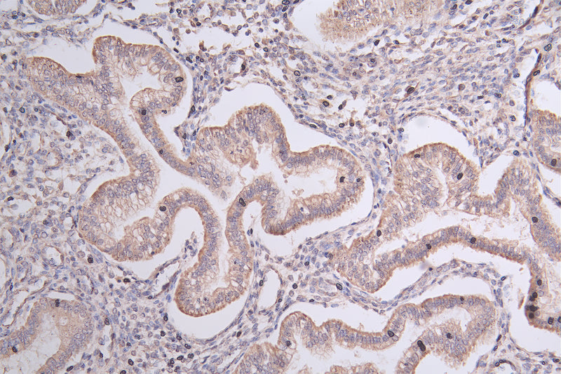Immunohistochemistry of paraffin-embedded human endometrial cancer using TRIM17 Antibody at dilution of 1:67Rabbit anti-Human TRIM17 Polyclonal Antibody