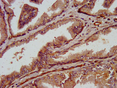 IHC image of TRPV2 Antibody diluted at 1:800 and staining in paraffin-embedded human prostate tissue performed on a Leica BondTM system. After dewaxing and hydration, antigen retrieval was mediated by high pressure in a citrate buffer (pH 6.0). Section was blocked with 10% normal goat serum 30min at RT. Then primary antibody (1% BSA) was incubated at 4°C overnight. The primary is detected by a biotinylated secondary antibody and visualized using an HRP conjugated SP system.Rabbit anti-Human TRPV2 Polyclonal Antibody