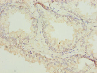 Immunohistochemistry of paraffin-embedded human prostate cancer using ACTL7B Antibody at dilution of 1:100