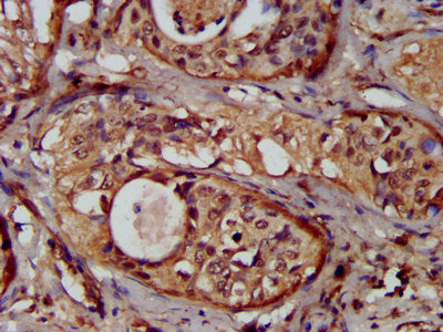 IHC image of the antibody diluted at 1:300 and staining in paraffin-embedded human cervical cancer performed on a Leica BondTM system. After dewaxing and hydration, antigen retrieval was mediated by high pressure in a citrate buffer (pH 6.0). Section was blocked with 10% normal goat serum 30min at RT. Then primary antibody (1% BSA) was incubated at 4°C overnight. The primary is detected by a biotinylated secondary antibody and visualized using an HRP conjugated SP system.Rabbit anti-Human NUMBL Polyclonal Antibody
