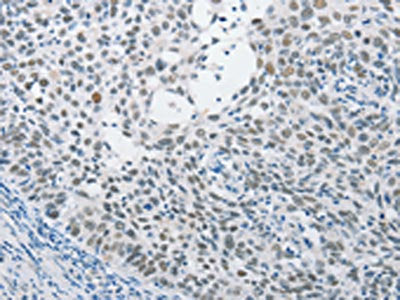 The image on the left is immunohistochemistry of paraffin-embedded Human cervical cancer tissue using SAE1 Antibody(SAE1 Antibody) at dilution 1/15, on the right is treated with fusion protein. (Original magnification: ×200)Rabbit anti-Human SAE1 Polyclonal Antibody