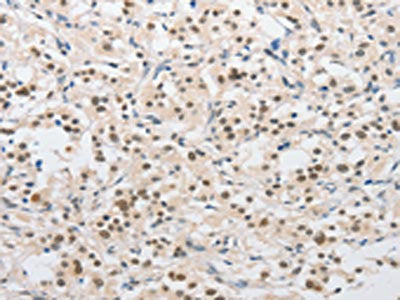 The image on the left is immunohistochemistry of paraffin-embedded Human thyroid cancer tissue using the antibody Antibody) at dilution 1/15, on the right is treated with fusion protein. (Original magnification: ×200)Rabbit anti-Human SAE1 Polyclonal Antibody