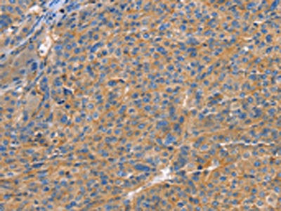 The image on the left is immunohistochemistry of paraffin-embedded Human liver cancer tissue using GNB1 Antibody(GNB1 Antibody) at dilution 1/20, on the right is treated with fusion protein. (Original magnification: ×200)Rabbit anti-Human GNB1 Polyclonal Antibody