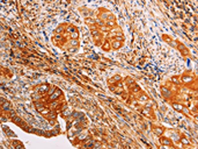 The image on the left is immunohistochemistry of paraffin-embedded Human cervical cancer tissue using SLC25A4 Antibody(SLC25A4 Antibody) at dilution 1/40, on the right is treated with synthetic peptide. (Original magnification: ×200)Rabbit anti-Human SLC25A4 Polyclonal Antibody