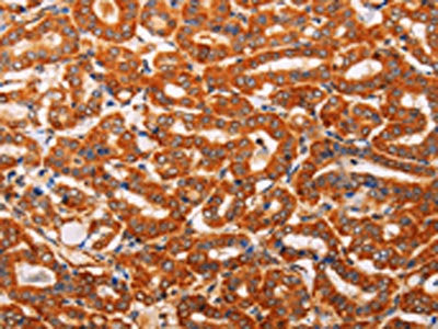 The image on the left is immunohistochemistry of paraffin-embedded Human thyroid cancer tissue using the antibody Antibody) at dilution 1/40, on the right is treated with synthetic peptide. (Original magnification: ×200)Rabbit anti-Human SLC25A4 Polyclonal Antibody