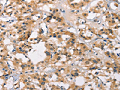 The image on the left is immunohistochemistry of paraffin-embedded Human thyroid cancer tissue using MARC1 Antibody(MARC1 Antibody) at dilution 1/40, on the right is treated with synthetic peptide. (Original magnification: ×200)