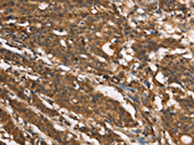 The image on the left is immunohistochemistry of paraffin-embedded Human gastic cancer tissue using the antibody Antibody) at dilution 1/40, on the right is treated with synthetic peptide. (Original magnification: ×200)